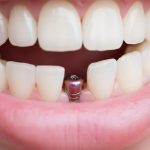 Diş Tedavisinde Devrim: İmplantı SGK Karşılayacak